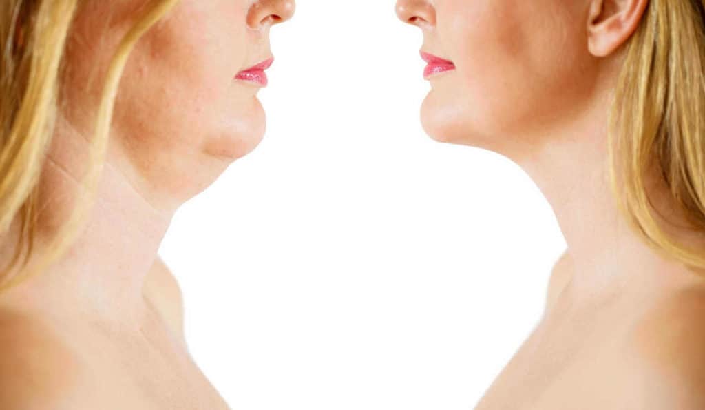 Double Chin treatment Leicestershire before and after results