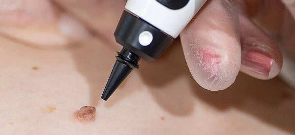 After Skin Tag Removal Leicestershire