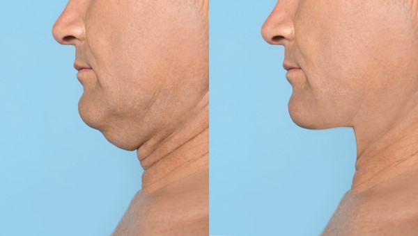 Which Non-Surgical Treatments Work Best for Jowls and Loose Skin Leicestershire?