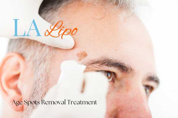 What Are the Most Effective Treatments for Age Spots Leicestershire?
