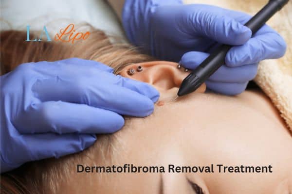 Dermatofibroma Removal Treatment Leicestershire