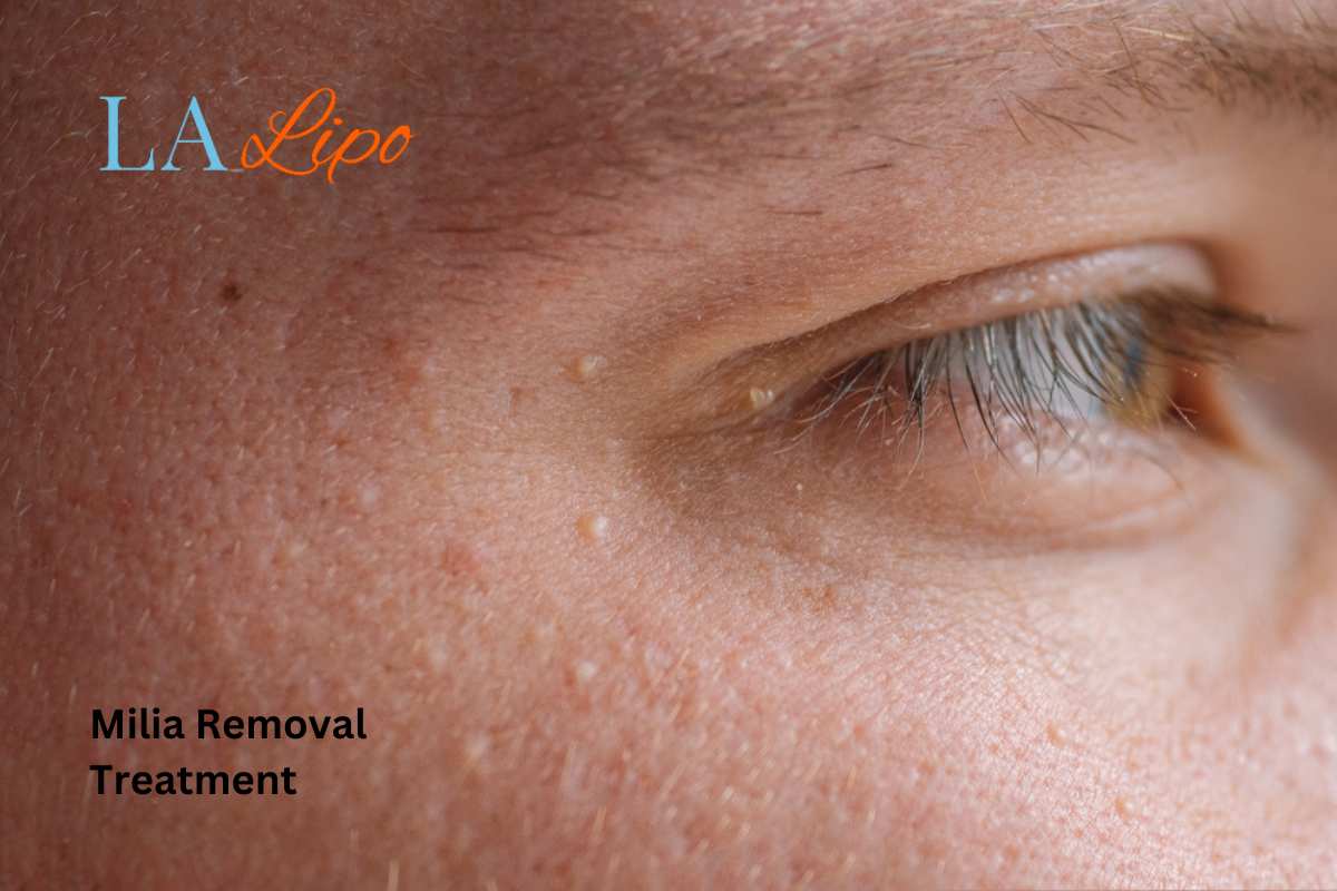 Cryopen Milia Removal: Is It the Easiest and Safest Option Leicestershire?
