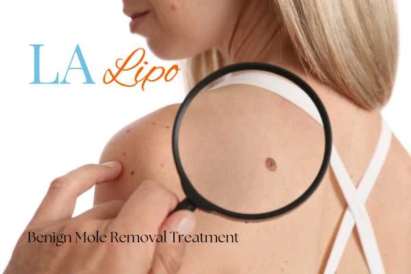Woman having her inspection of blemish before mole removal Leicestershire