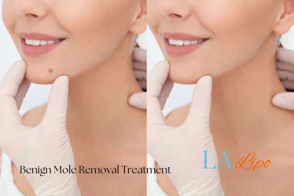 woman's before and after mole removal Leicestershire results