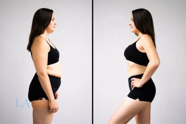 image of woman before and after results of LA-EMS Body Sculpting Leicestershire to help treat Diastasis recti