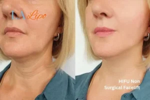hi-fu for wrinkles Leicestershire before and after results