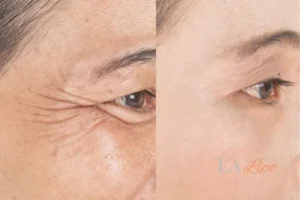 Before and after results of woman - HI-fu wrinkles reduction treatment Leicestershire
