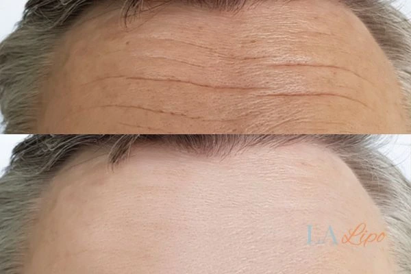 results of HIFU Leicestershire on mans forehead to help reduce lines and wrinkles