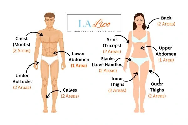 LA LIPO Cryolipolysis Areas Leicestershire