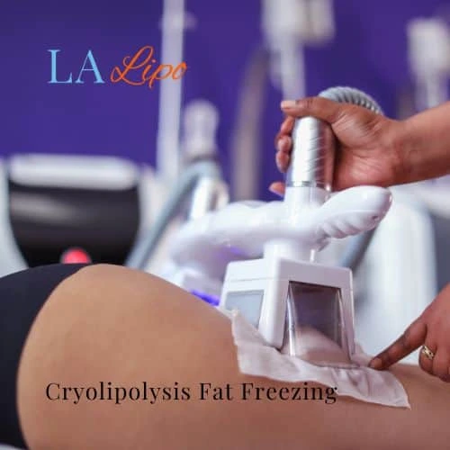 fat freezing - Cryolipolysis Leicestershire