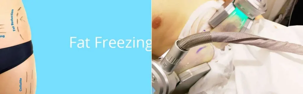 Fat freezing Leicestershire on multiple areas of the body