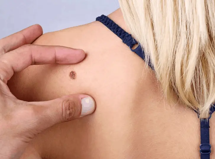 woman having mole removal Leicestershire consultation before treatment.