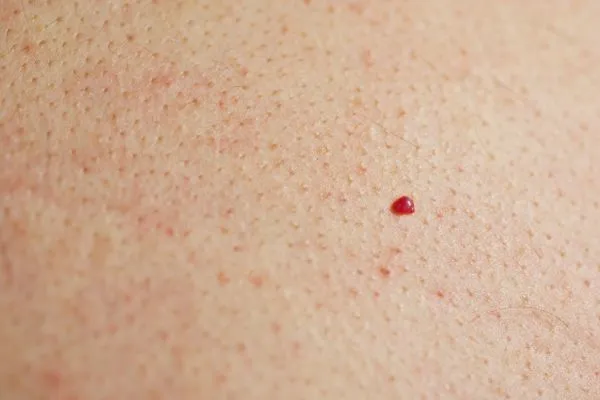 close up of a cherry angioma Leicestershire