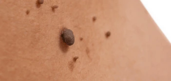 image of a skin tag Leicestershire