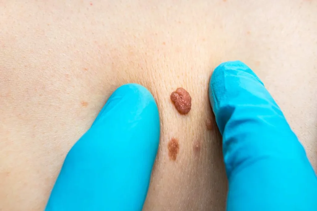 Consultant examining a skin tag Leicestershire