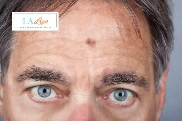 Solar Lentigo Removal Leicestershire image of man with mark on his forehead