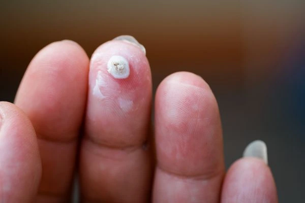 wart on person finger - cryotherapy to treat from LA LIPO Leicestershire