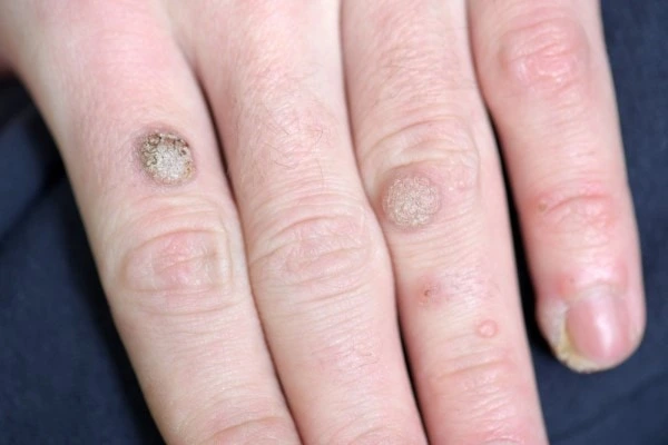 photo of warts on person hand - see wart removal Leicestershire from LA LIPO