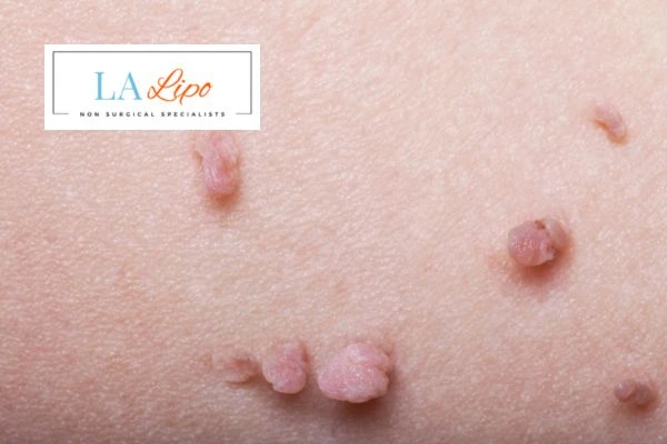 Does cryopen skin tag removal Leicestershire hurt? Find out now call our team today!
