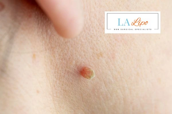 Book skin tag removal Leicestershire today speak to our team now!