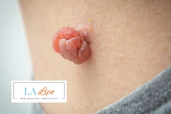 Interested in skin tag removal Leicestershire? Concerned about the pain? Find out more today!