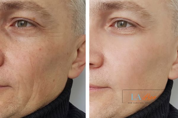 See the amazing results of Morpheus8 Treatment Leicestershire!