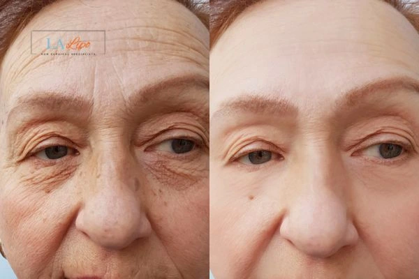 The powerful benefits of Morpheus8 Treatment Leicestershire - Call Our team today!