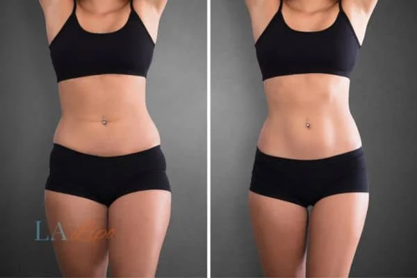 before and after results of non-surgical treatment to help a woman's body image and mental health Leicestershire