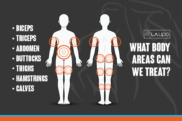 Diagram to show areas you can have LA-EMS Body Sculpting Treatment Leicestershire