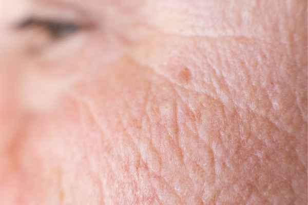 close up picture of a woman's face showing an age spot Leicestershire