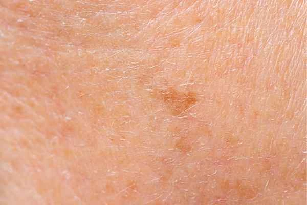 close up picture of age spots Leicestershire