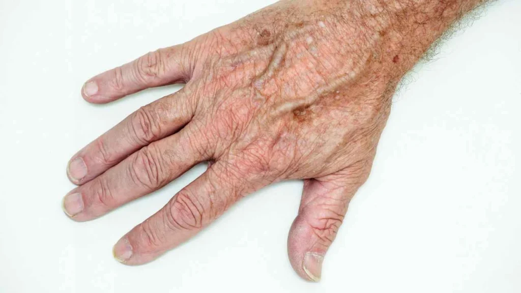 Male hand showing age spot Leicestershire