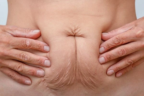 Image of a woman's stomach with loose skin - example of skin tightening Leicestershire options