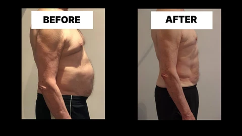 What Symptoms Can Diastasis Recti Cause in Men? Weak Core, Back Pain and Poor Posture Leicestershire